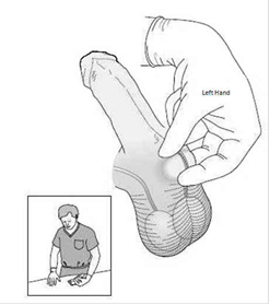 Technika trzech palców dla unieruchamiania lewego nasieniowodu (praworęczny chirurg)