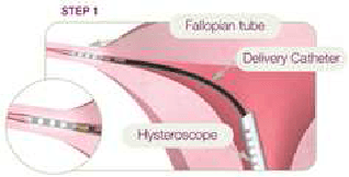 cienkie, elastyczne narzędzie (cewnik ) wprowadzone przez histeroskop do jamy macicy