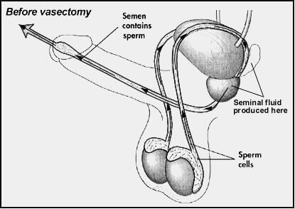 przed wazektomią
