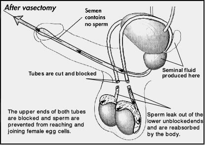 po wazektomii