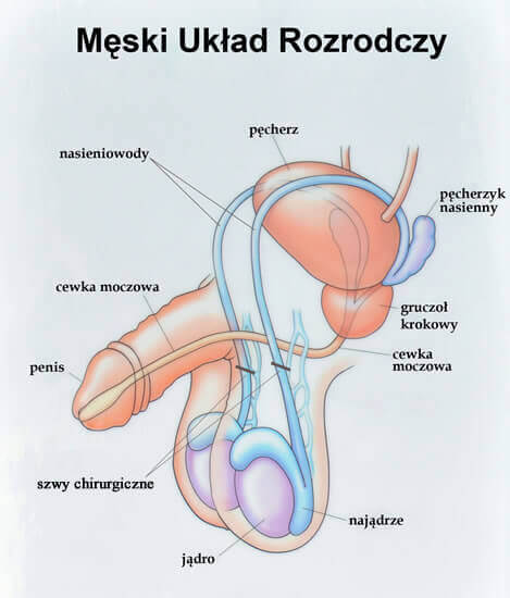 Schema des Verlaufs der Samenleiter. An der eingezeichneten Unterbindungsstelle wird der Samenleiter mit chirurgischem Faden abgebunden und ein mehrere Millimeter langes Teilstück entfernt.