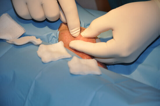 Vas deferens is easy to detect under the surface of the skin, it even bulges slightly.