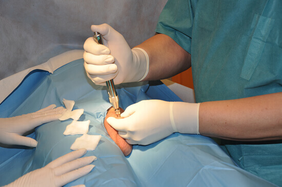 Beginning of anesthesia. The anesthetic is applied under the surface of the skin under certain pressure which feels like a rubber band snap. After the last snap-snap we can continue the procedure.