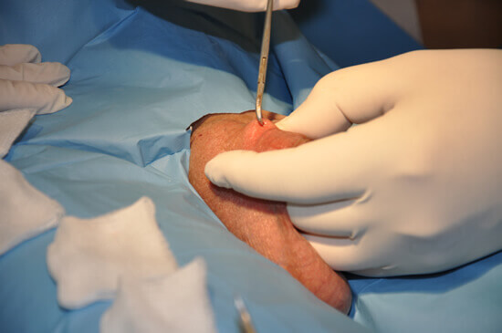 El conducto deferente anastesiado es fijado con la pinza de anillo. Una fijación adecuada del conducto deferente es el principio y el final del tratamiento. El resto del procedimieto es muy simple.